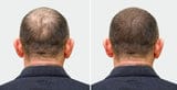 Hair Regrowth Oil + Hair Regrowth Shampoo (Free)